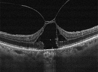 vmt eye condition