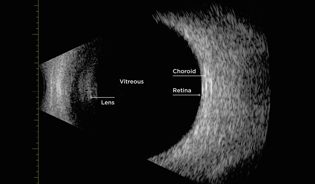 Normal B-scan