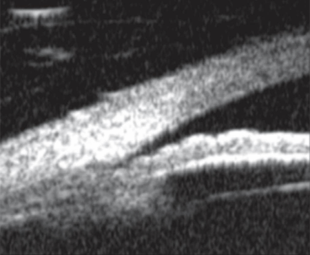 Normal UBM scan