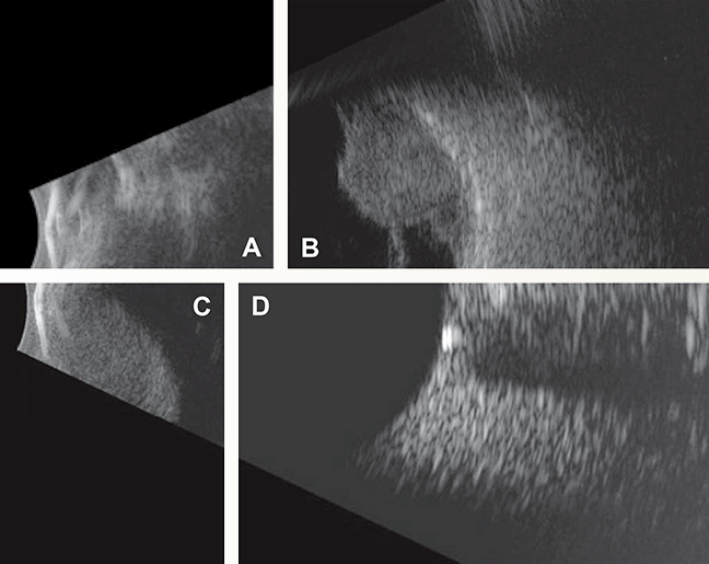 Four views of pathology on B-scan